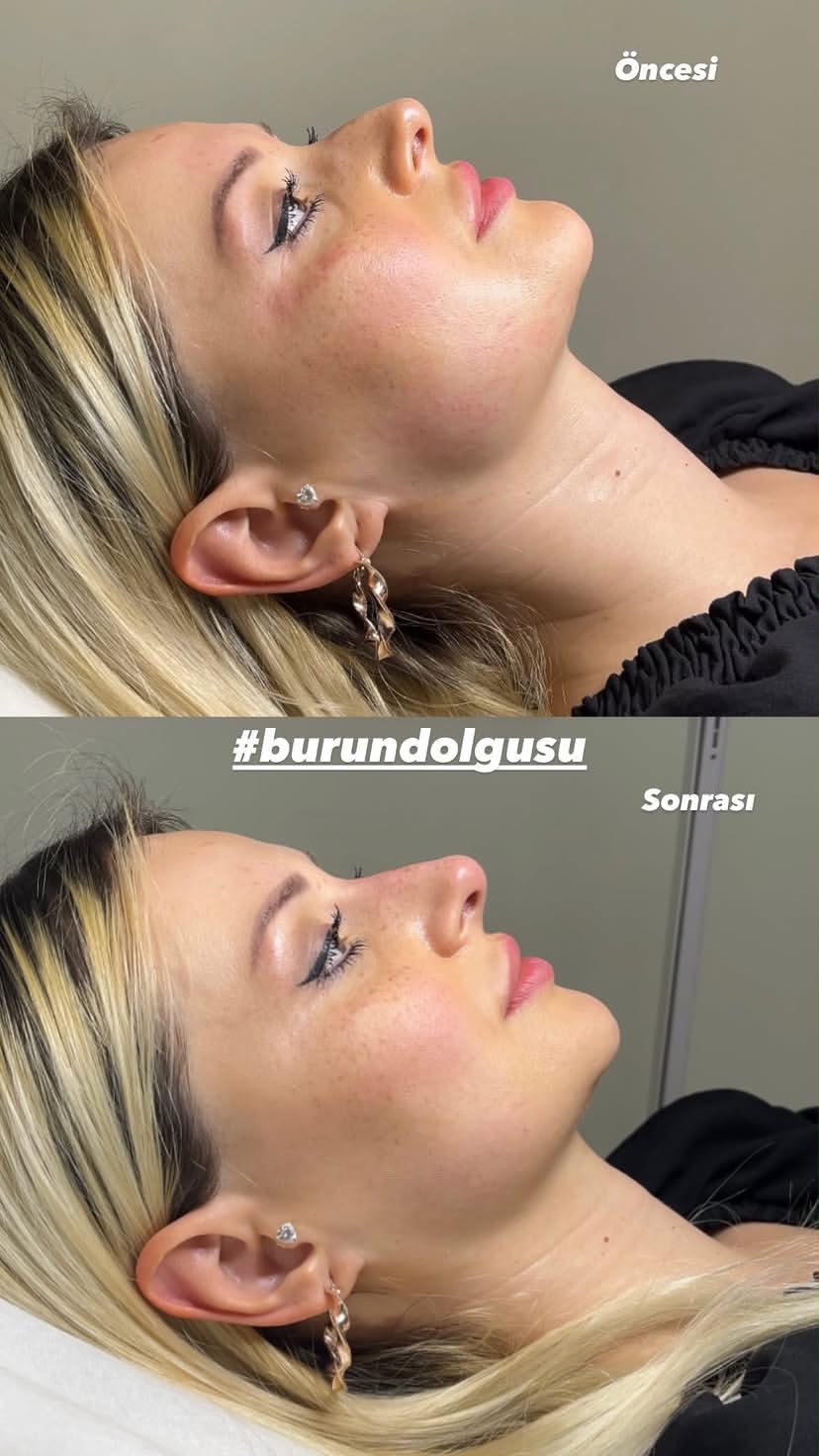 Burun dolgusu sonucu